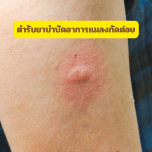 ตำรับยาบำบัดอาการแมลงกัดต่อย